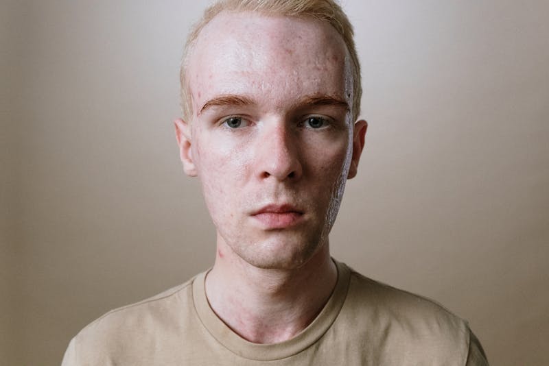 Ayurvedic Healing for Skin Wellness